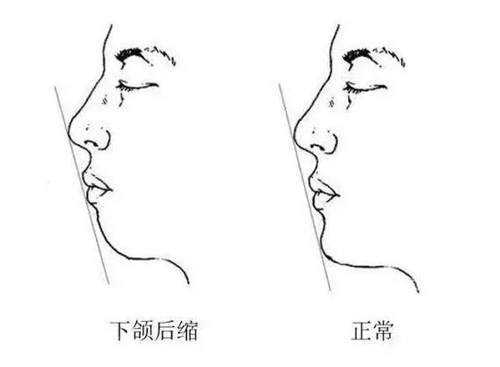 怎樣判斷下巴是否短縮