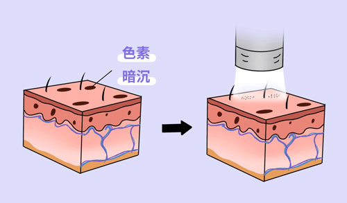 想要嫩膚，應該選擇做光電還是水光